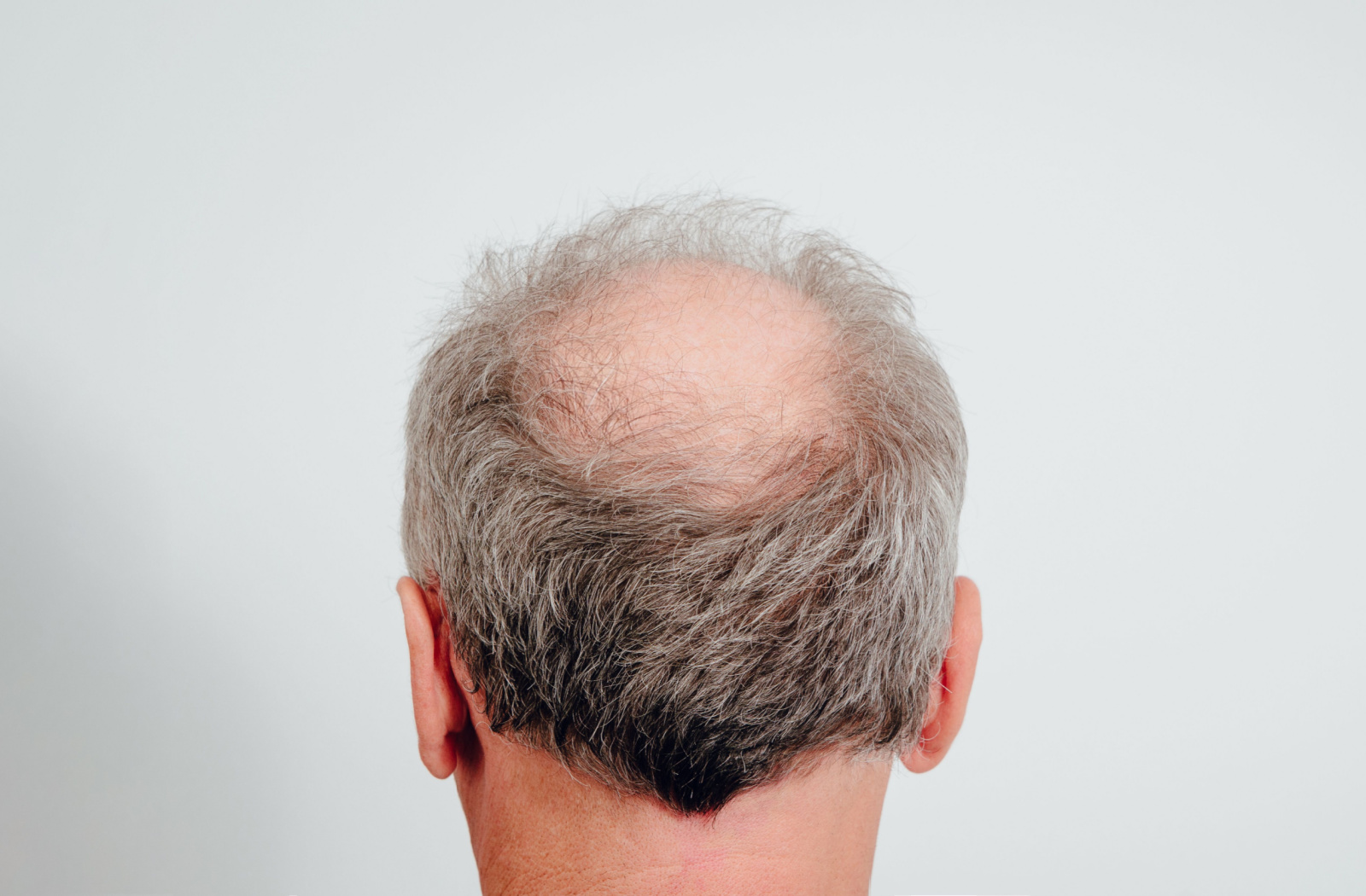 A rear view of an elderly man's head shows massive hair loss due to low level of testosterone.